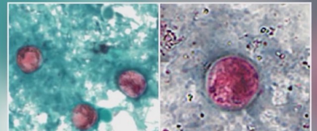Nationwide Cyclospora Outbreak Linked to Contaminated Produce Surge