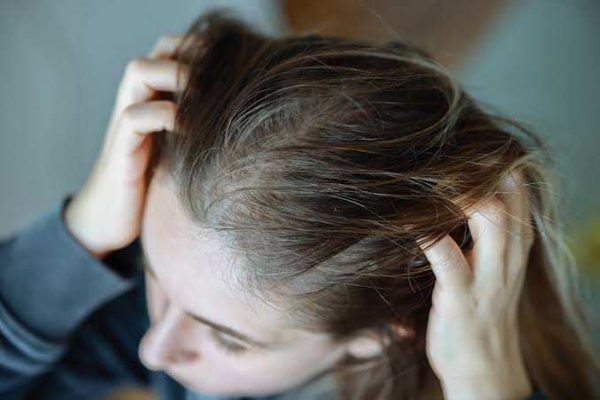 可能导致女性脱发的3种常见健康状况