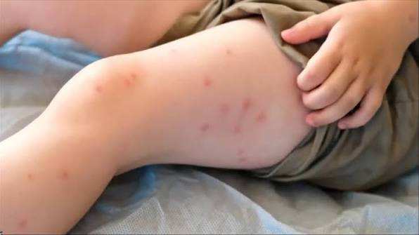Brote de Sarampión en Kentucky Alcanza 157 Casos