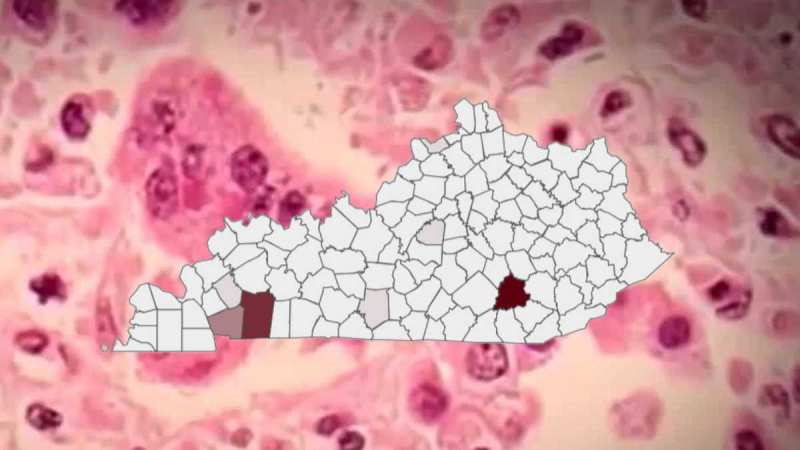 Brote de Sarampión en Kentucky Alcanza 157 Casos