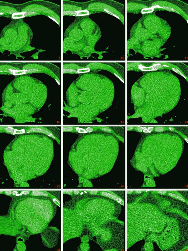 Diagnostic d'une jeune patiente encourage le dépistage précoce du cancer