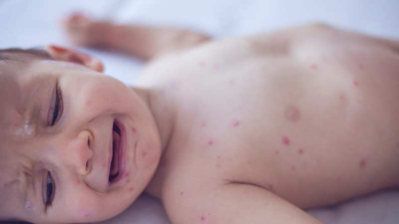 Pennsylvania Issues Health Alert Over Rising Congenital Measles Cases