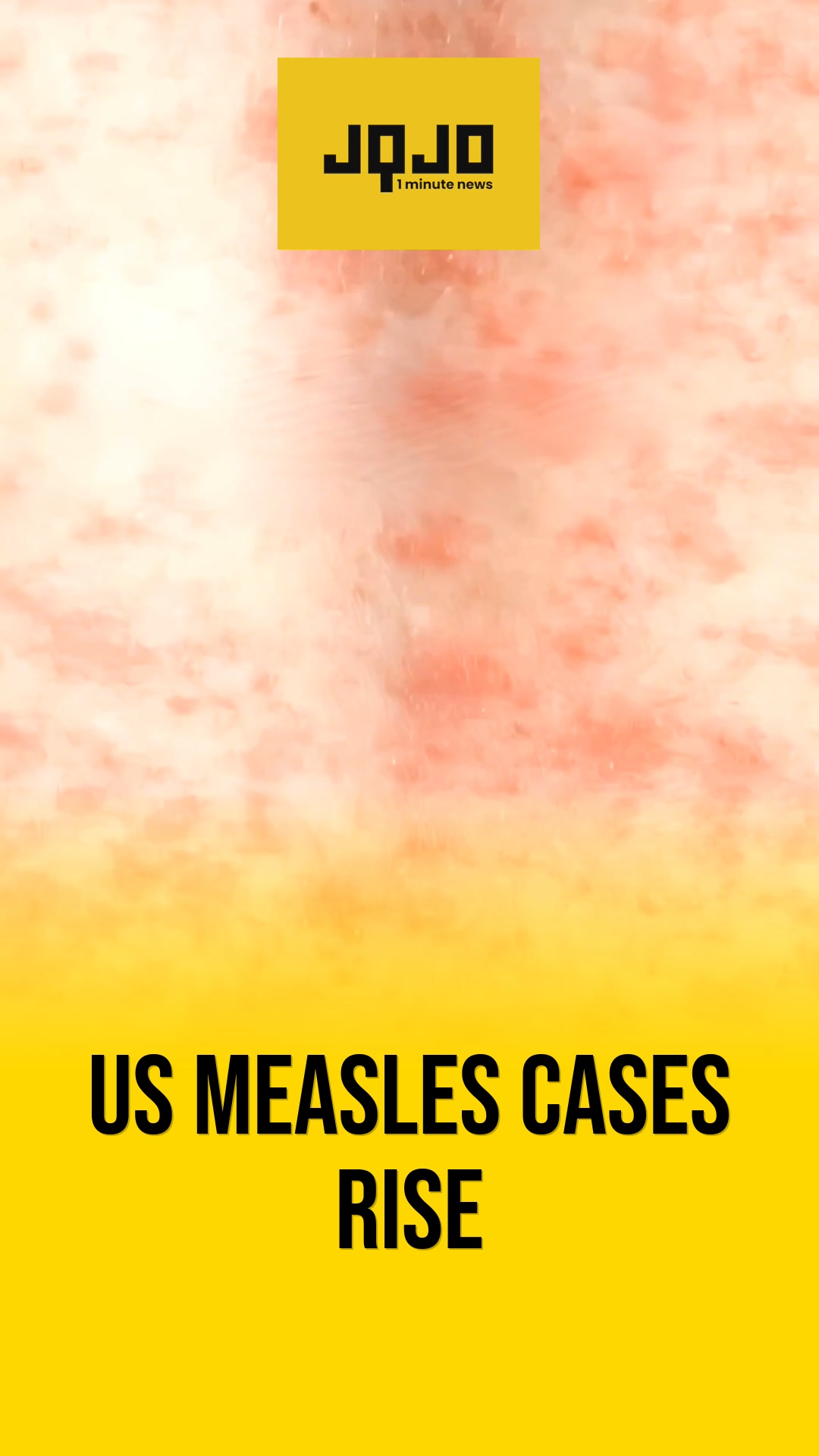 United States measles cases surpass last year